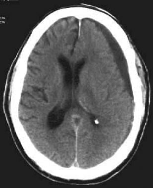 Left-side chronic subdural hematoma (SDH). Note ef