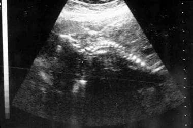 Ultrasound demonstrating a fetus in breech present