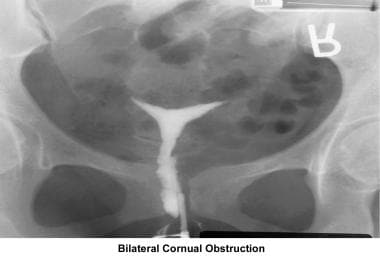 Infertility. Bilateral cornual obstruction. Image 