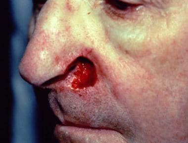 Postoperative wound after Mohs micrographic surger