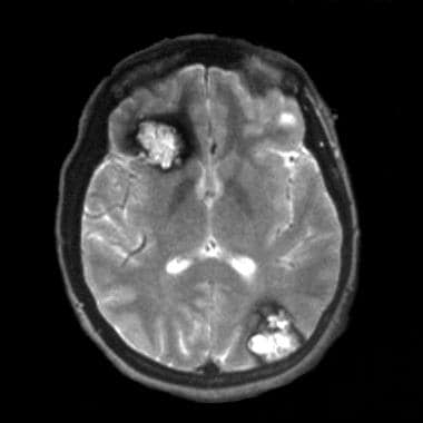 Gradient-echo axial MRI demonstrates increased con