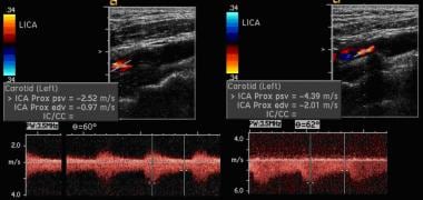 Pulsed Doppler waveforms in the same patient demon