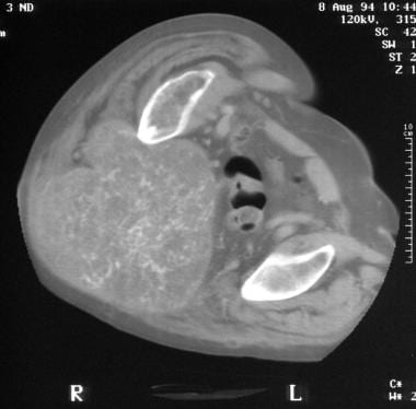 Computed tomography scan of sacrococcygeal chordom