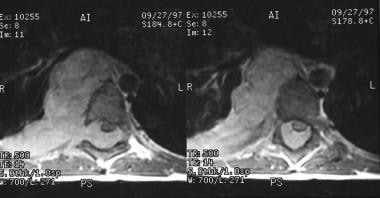 T1-weighted postcontrast axial images of a ganglio