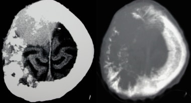 Transverse axial CT on brain and bone windows show