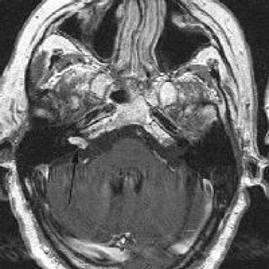 Magnetic resonance image (MRI) in a 62-year-old ma