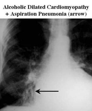Magnified right chest radiograph shows an area of 