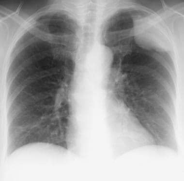 Posteroanterior chest radiograph in a 70-year-old 