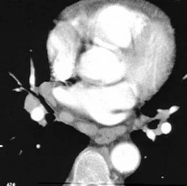 Computed tomography angiogram in a 55-year-old man