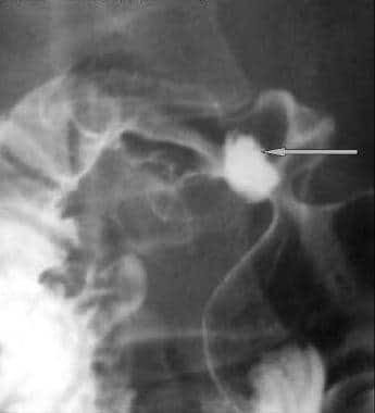 Double-contrast upper gastrointestinal series. Pos