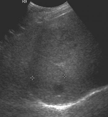 Ultrasound in a patient with von Gierke disease (g