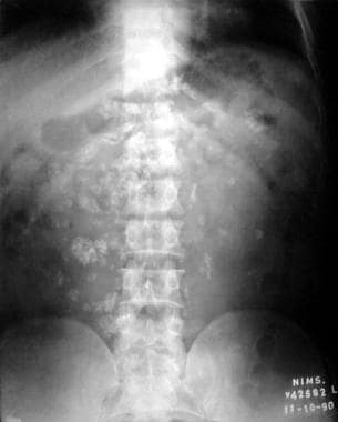 Plain radiograph of abdomen with diffuse calcified