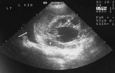 Sonogram of the left kidney in a 45-year-old woman