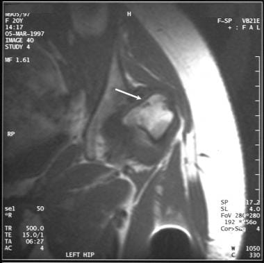 Coronal T1-weighted MRI of the left hip in the pat