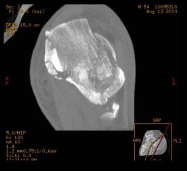 Calcaneus, fractures. CT scan. 