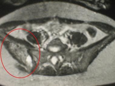 T2-weighted transverse MR image of the pelvis of a