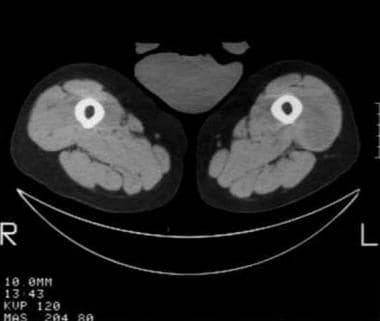 CT reveals a mass within the anterior compartment 