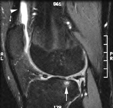Sagittal T2-weighted image 1 year after injury rev