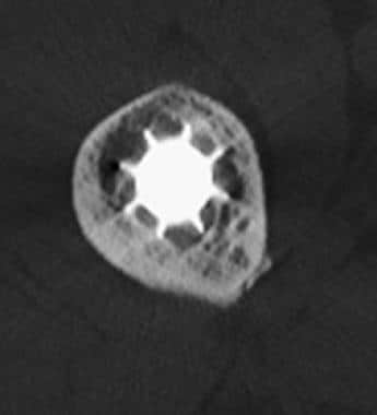 Axial CT of a cementless femoral stem tip with spl