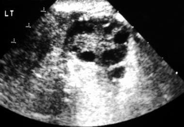 Transverse endovaginal sonogram of the left ovary.