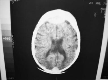 This patient has enhancing dural metastases near t