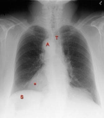 Posteroanterior chest radiograph in a 40-year-old 