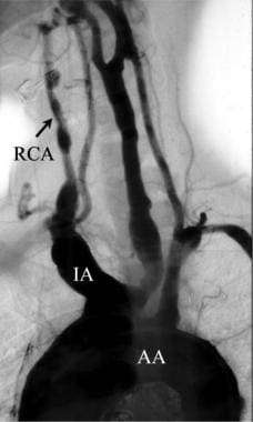 Thoracic arch angiography was performed with a 5F 