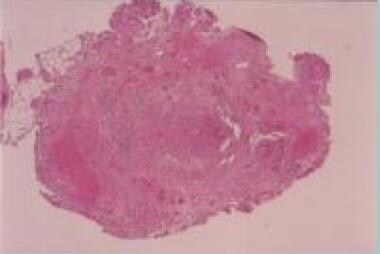 Hematoxylin- and eosin-stained superficial tempora