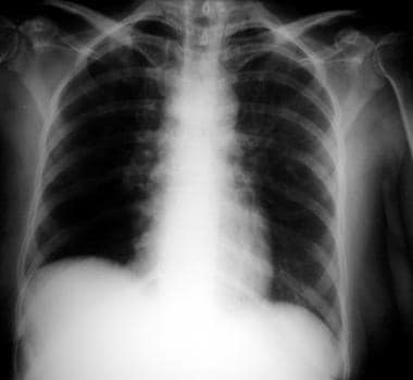 Chest radiograph in a patient with HIV infection, 
