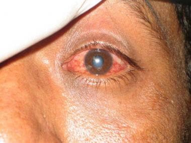 foreign body in eye