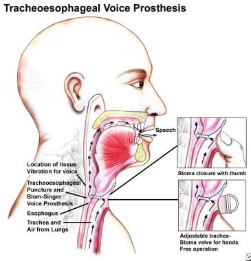 Diagram of tracheoesophageal puncture and prosthes
