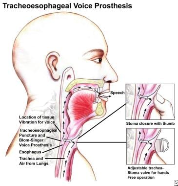 Laryngectomy Rehabilitation