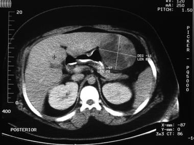 CT scan revealing hepatic adenoma arising from the