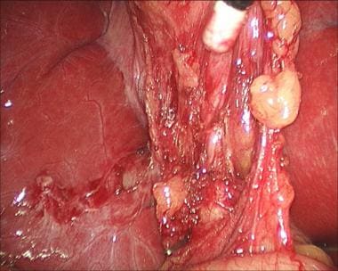 Laparoscopic cholecystectomy. Use of Endo Peanut t
