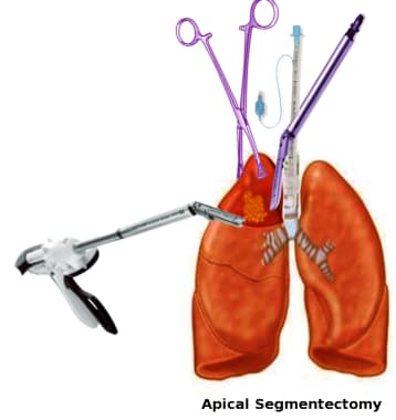 Apical segmentectomy.