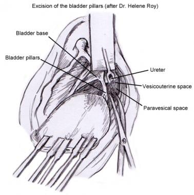 图6(图11):膀胱柱切除