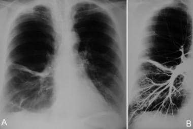 (A) Anteroposterior chest radiograph shows increas
