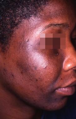 Minocycline "muddy" pigmentation of the face in ph