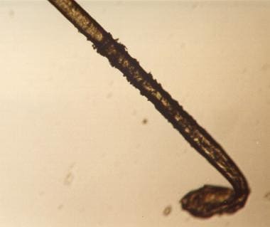 Microscopic view of easily plucked hair demonstrat