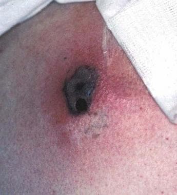 Primary cutaneous aspergillosis at a site of an in