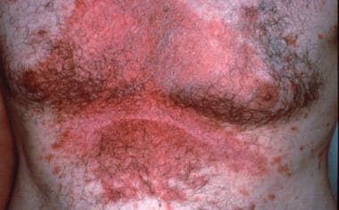 Seborrheic dermatitis may affect any hair-bearing 