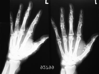 Radiograph of a patient's hands showing enchondrom