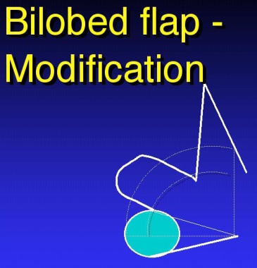 Bilobed flap modification. 