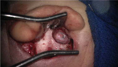 Intraoperative image of the right ear with the fas