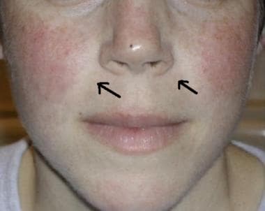 Is It Possible To Have a Malar Rash on One Side of the Face?