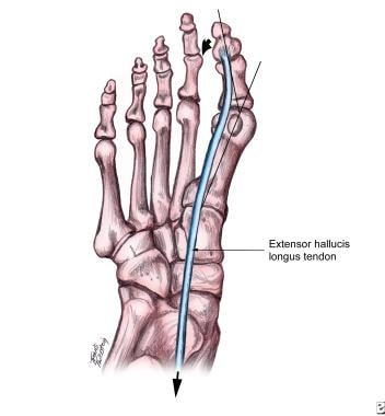 Line of pull of extensor hallucis longus causing m