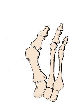 Anatomy of the plantar aspect of the foot demonstrating the bands