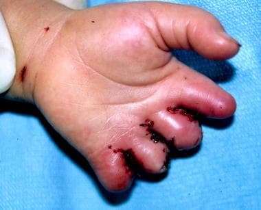 Left hand of 1.5-year-old patient with constrictio