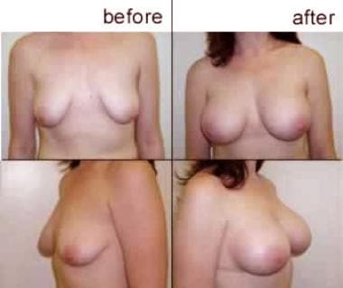 Breast augmentation, subglandular. Small B cup and