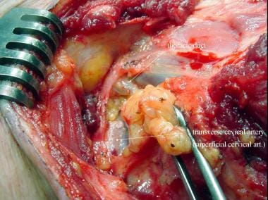 Intraoperative photo of the thoracic duct low in t